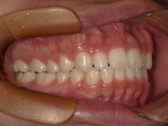 インビザライン症例 20代男性 術前