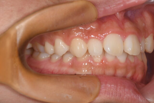 インビザライン症例 20代男性 術前